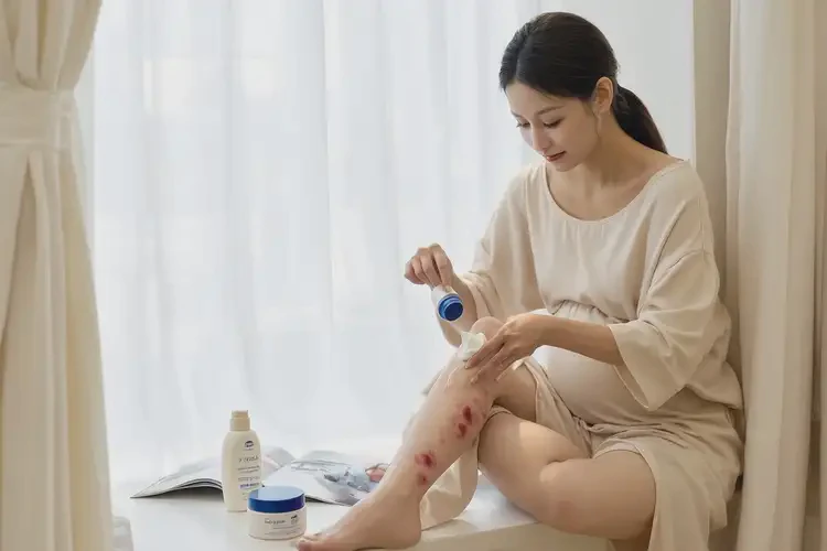 孕婦小腿上有濕疹可不可以徹底自愈(圖3)