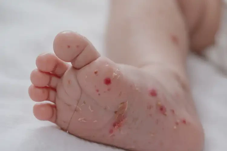 新生兒腳上經(jīng)常長濕疹不管它會(huì)自己好嗎(圖4)