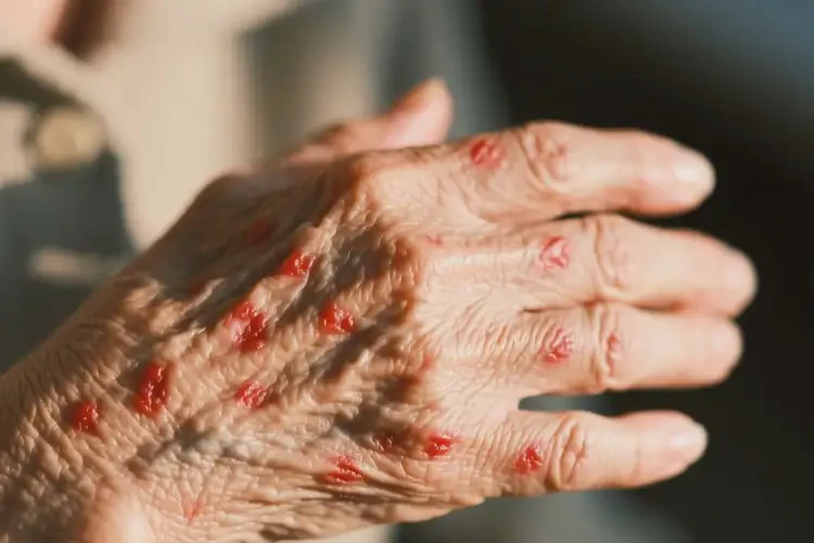 老年人身上起湿疹能不能彻底自愈(图4)