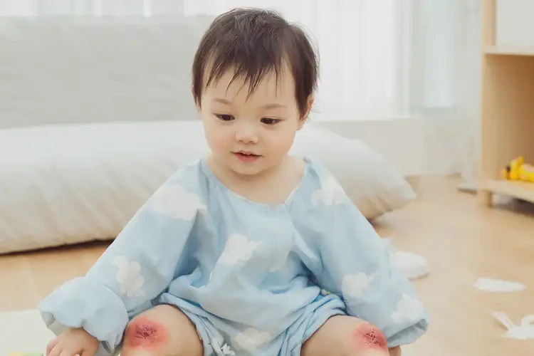 幼兒四肢經(jīng)常長濕疹不管它會(huì)自己好嗎(圖1)