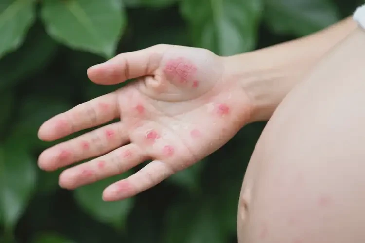 孕婦全身容易起濕疹不管它會(huì)自己痊愈嗎(圖4)
