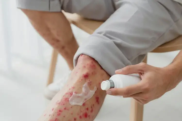 男性小腿容易起湿疹可以彻底自愈吗(图3)