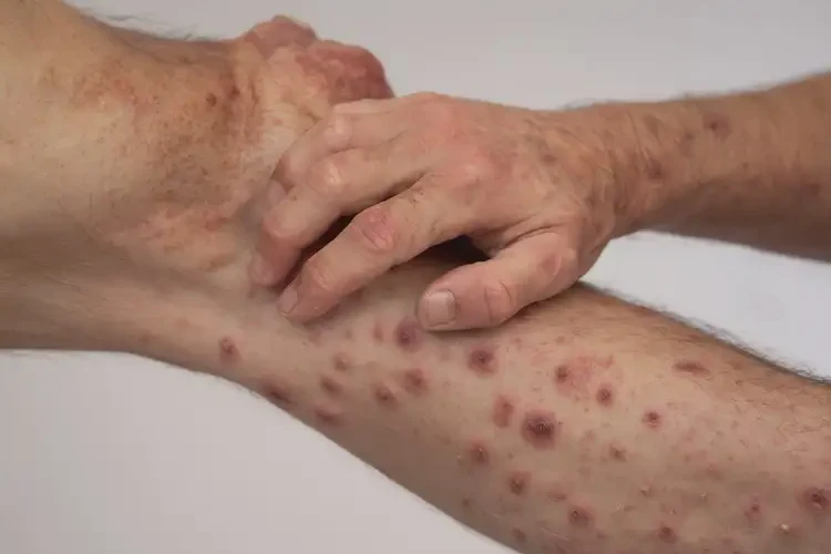 男性四肢容易起濕疹可以徹底自愈嗎(圖4)