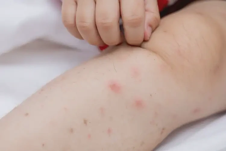 少兒小腿上偶爾長(zhǎng)濕疹不管它會(huì)自己自愈嗎(圖4)