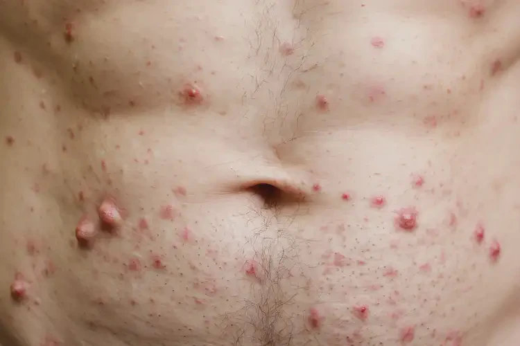 男生肚子上起濕疹能徹底自愈嗎(圖4)