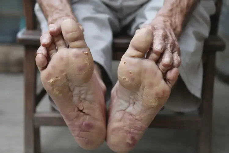 高齡老人腳上長濕疹能徹底自愈嗎(圖4)