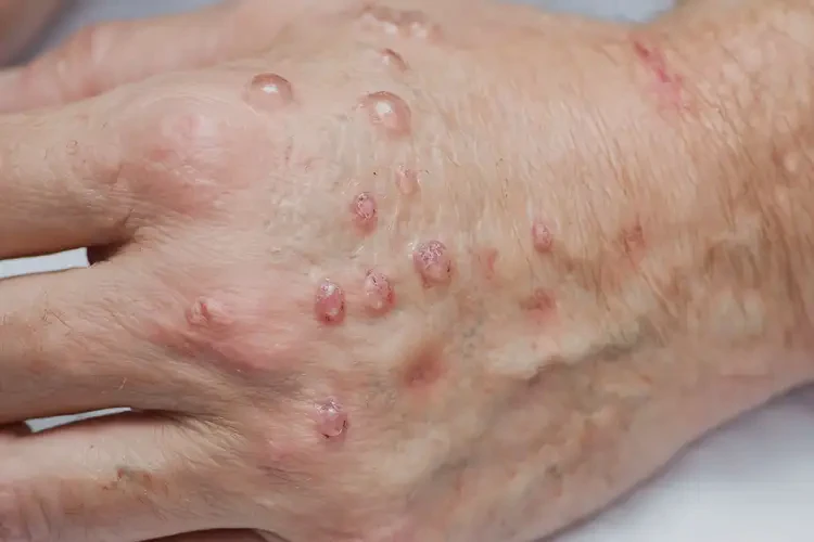 大學生手臂上偶爾長濕疹能徹底自愈嗎(圖2)