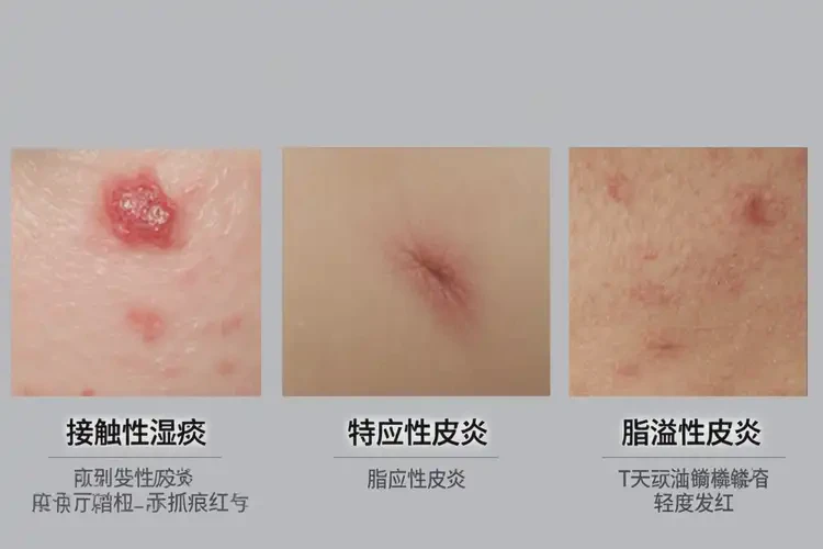 大學(xué)生肚子偶爾起濕疹不管它會(huì)自己自愈嗎(圖3)