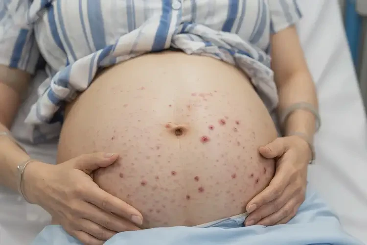 產(chǎn)婦肚子容易起濕疹能夠徹底治愈嗎(圖4)