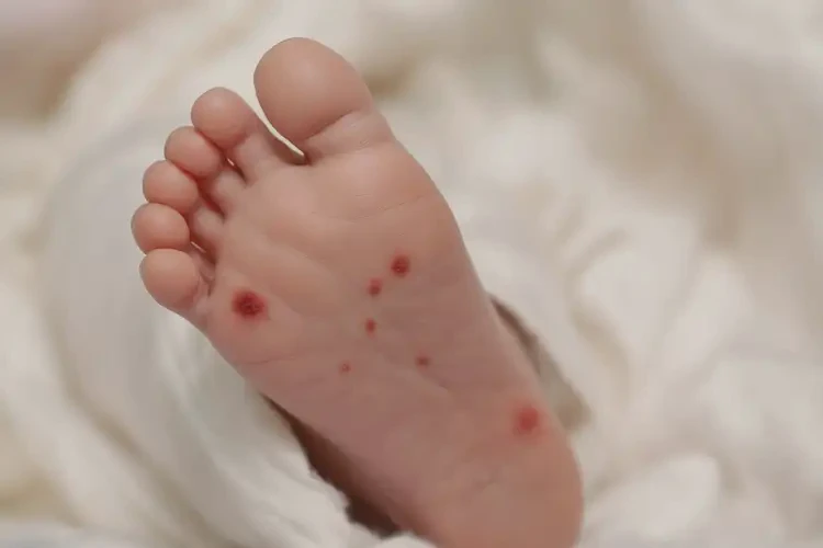 新生兒腳上起濕疹不管它會自己好嗎(圖4)