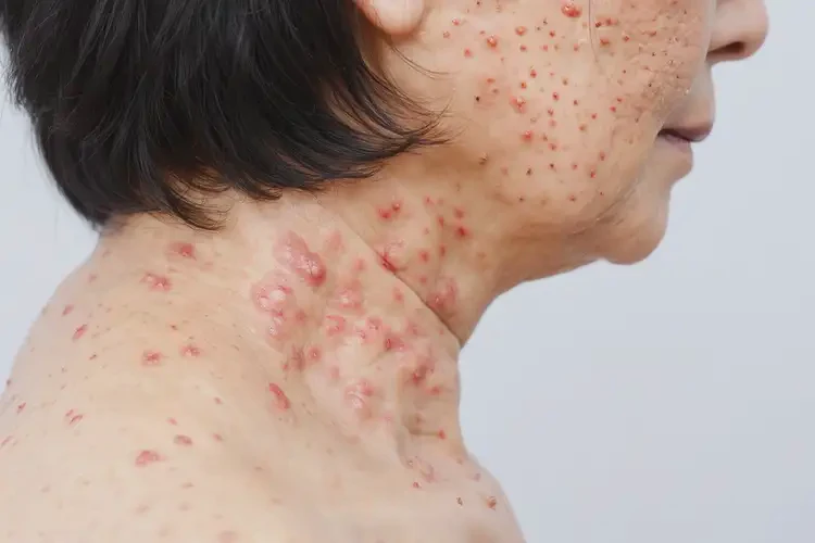 女性脖子容易长湿疹能彻底自愈吗(图4)