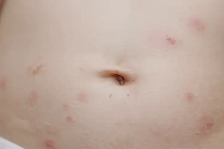 宝宝肚子上容易长湿疹能靠自己自愈吗(图4)