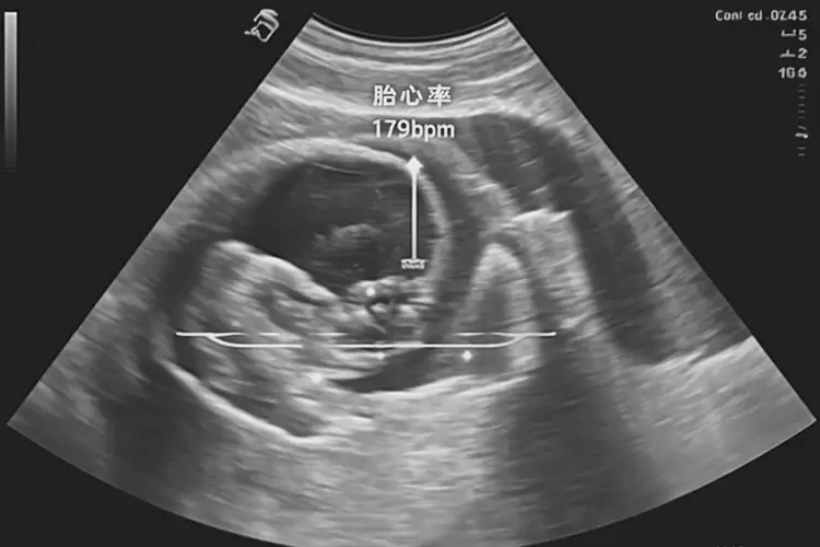 孕9周5天胎心179還能保住嗎(圖4)