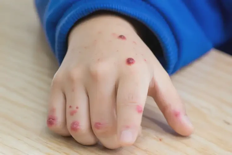 小學(xué)生手上出現(xiàn)濕疹不管它會自己痊愈嗎(圖4)