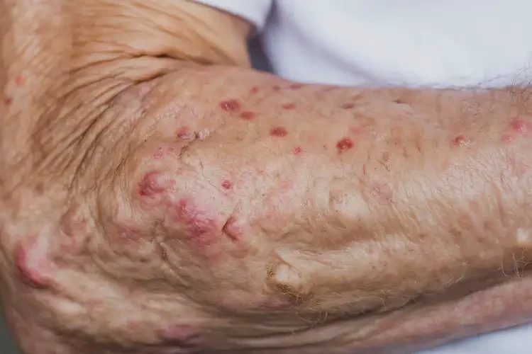 老年人手臂上長(zhǎng)濕疹不管它會(huì)自己自愈嗎(圖4)