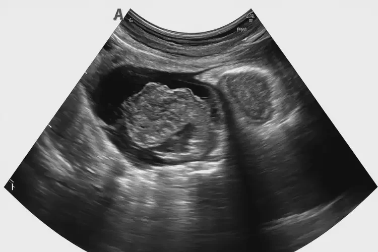 懷孕第17周胎心率85寶寶還能要嗎(圖2)