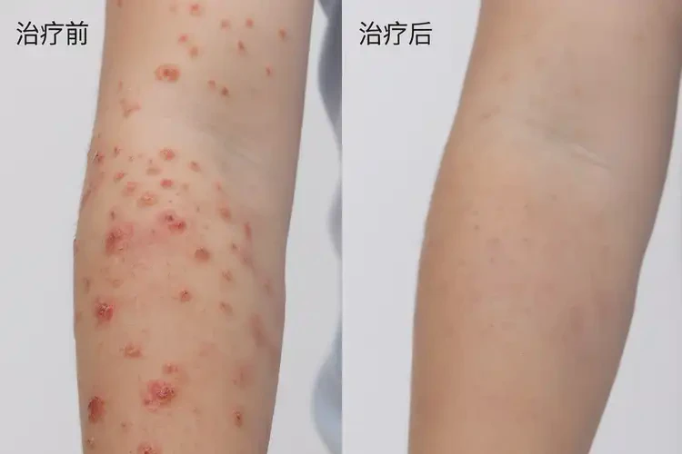 孩子身上長(zhǎng)濕疹不管它會(huì)自己痊愈嗎(圖1)