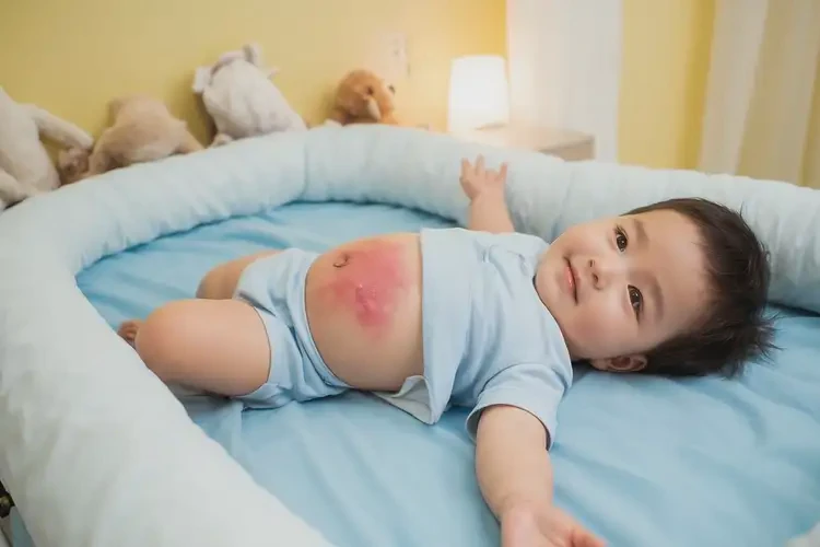 幼兒肚子經(jīng)常起濕疹能不能徹底自愈(圖1)