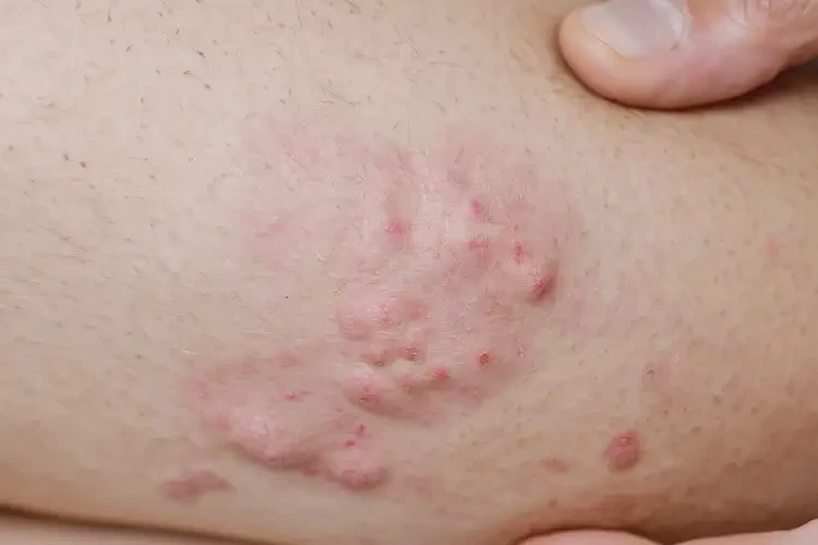 男人大腿上經(jīng)常起濕疹不管它會自己自愈嗎(圖4)