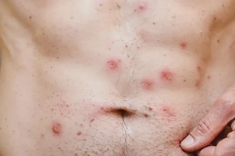 男性肚子長(zhǎng)濕疹不管它會(huì)自己痊愈嗎(圖4)