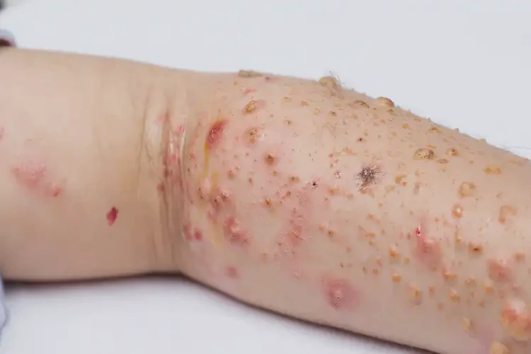 少儿手臂上起湿疹不管它会自己好吗(图2)