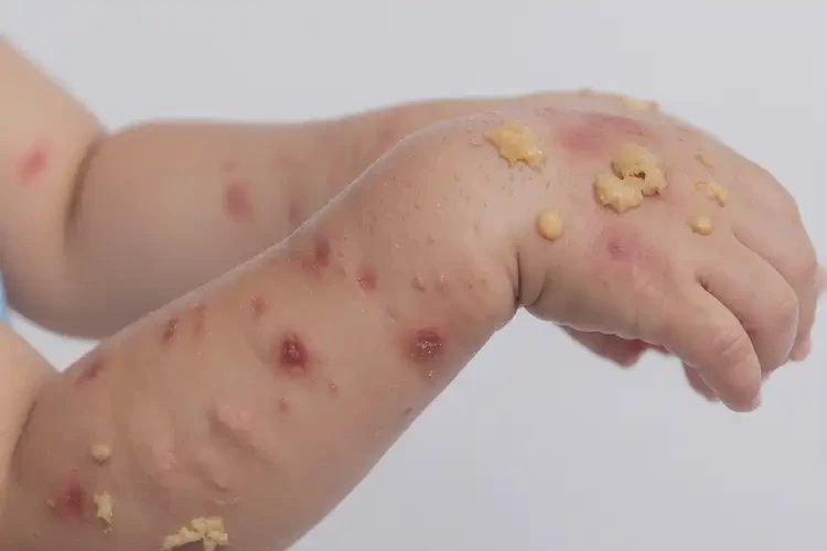 儿童手臂出现湿疹能彻底自愈吗(图2)