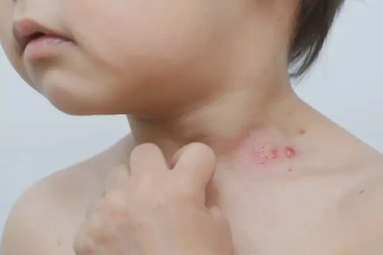 兒童脖子偶爾長濕疹不管它會自己好嗎(圖4)