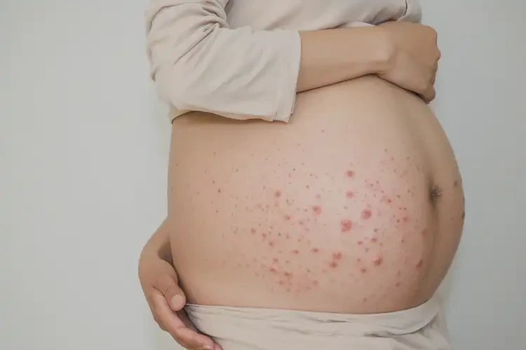 孕婦肚子偶爾起濕疹能靠自己自愈嗎(圖4)