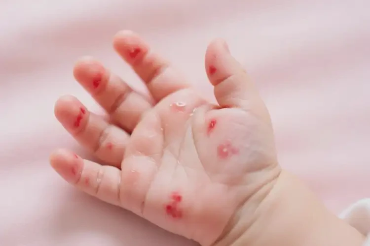 婴儿手上起湿疹不管它会自己自愈吗(图3)