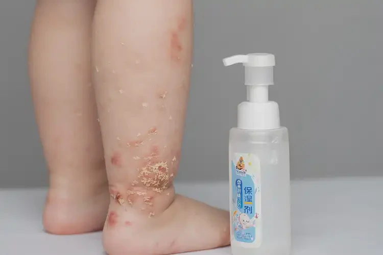 小孩屁股長(zhǎng)濕疹能夠徹底治愈嗎(圖3)