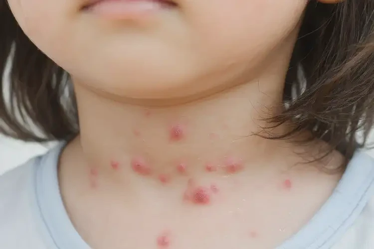 孩子脖子上偶爾起濕疹能靠自己自愈嗎(圖4)