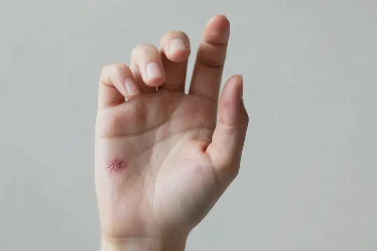 女性手上偶爾長(zhǎng)濕疹不管它會(huì)自己痊愈嗎(圖3)