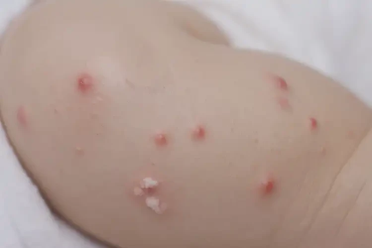 嬰幼兒大腿偶爾起濕疹能徹底自愈嗎(圖4)