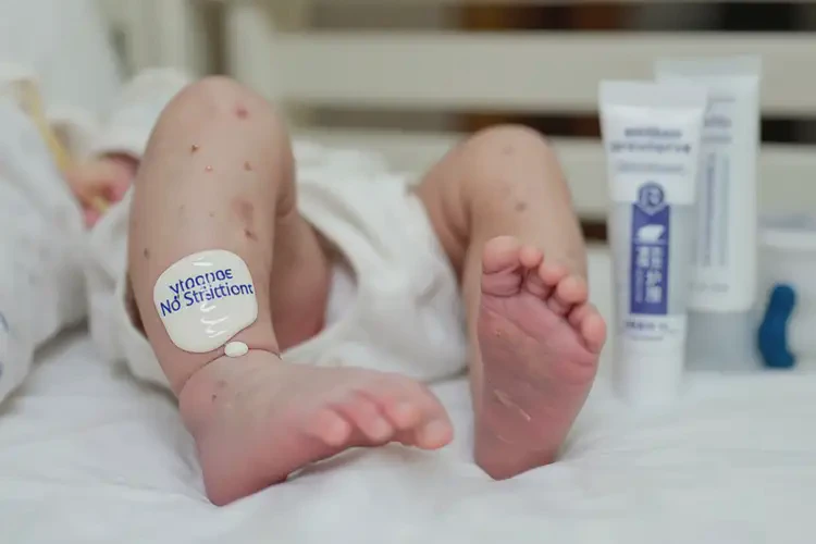 新生兒小腿上容易起濕疹可不可以徹底自愈(圖2)