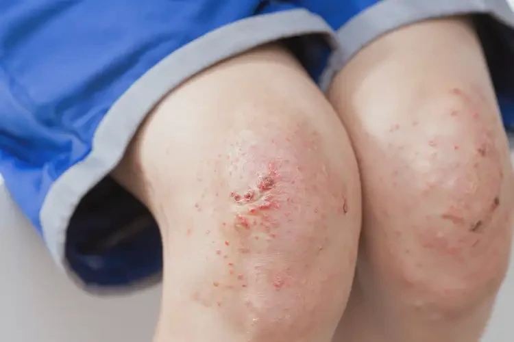 小學(xué)生大腿上容易起濕疹可以徹底自愈嗎(圖4)