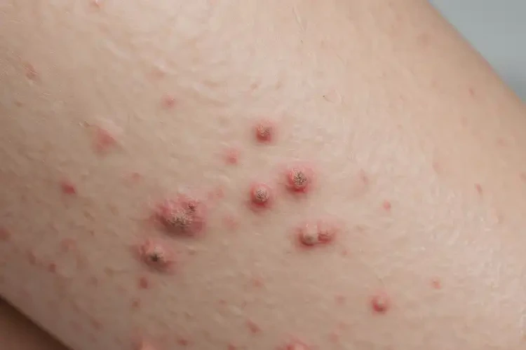 女人小腿容易長濕疹能不能徹底自愈(圖3)