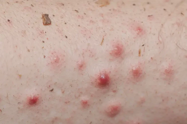 男生四肢有濕疹能夠徹底治愈嗎(圖4)