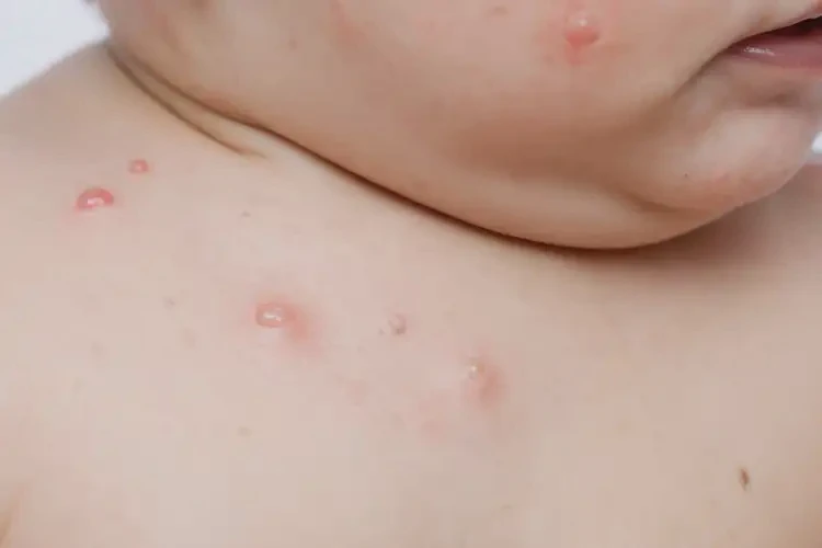 宝宝脖子上容易长湿疹能彻底自愈吗(图4)