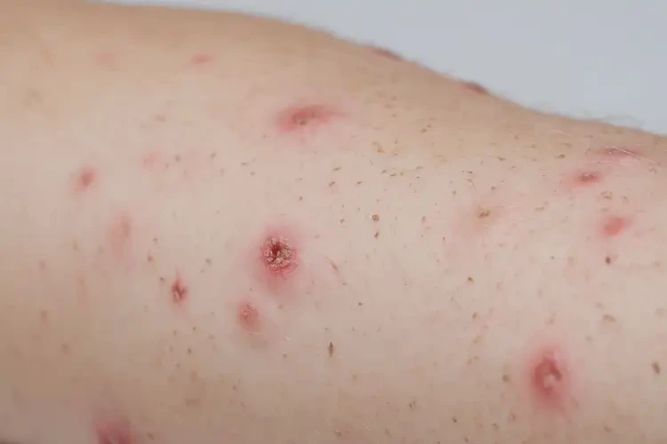 少儿手臂上起湿疹不管它会自己好吗(图4)