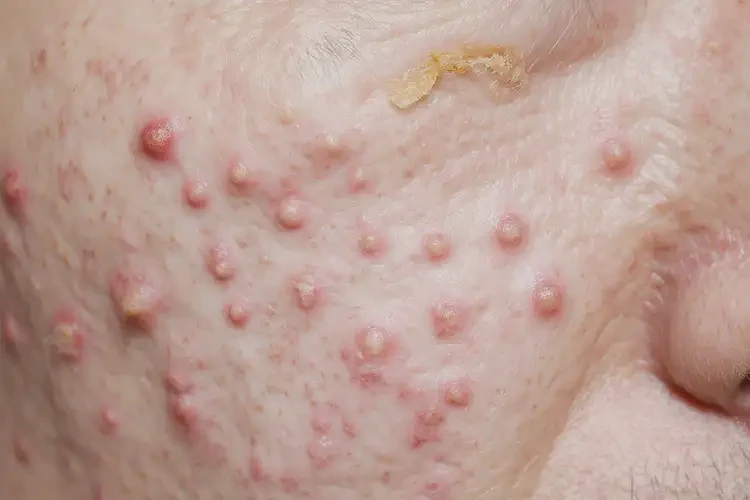 女生肚子上起濕疹不管它會自己好嗎(圖3)