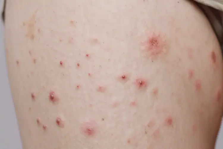 少兒大腿上經(jīng)常長濕疹不管它會自己痊愈嗎(圖4)