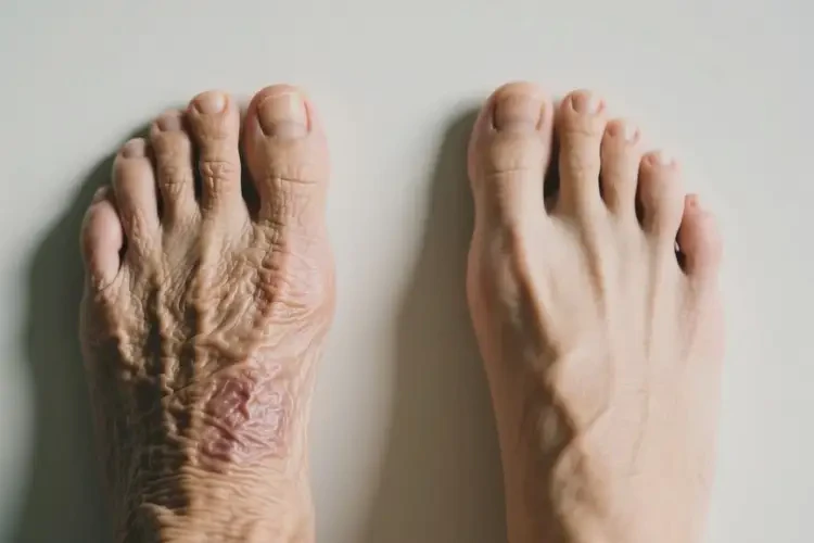 老年人腳上容易長(zhǎng)濕疹可不可以徹底自愈(圖3)