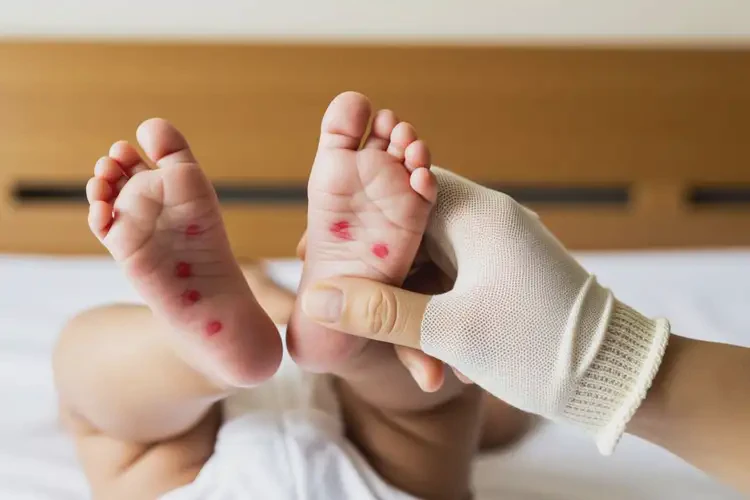 新生兒腳上出濕疹能徹底自愈嗎(圖1)