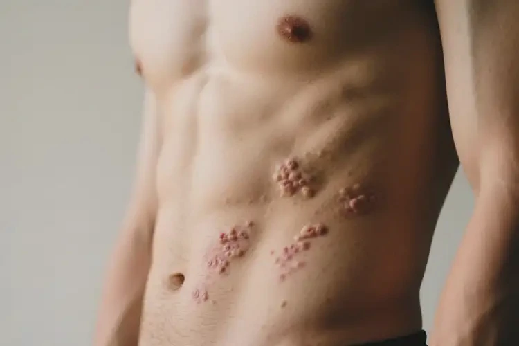 男性肚子上出現(xiàn)濕疹能徹底自愈嗎(圖2)