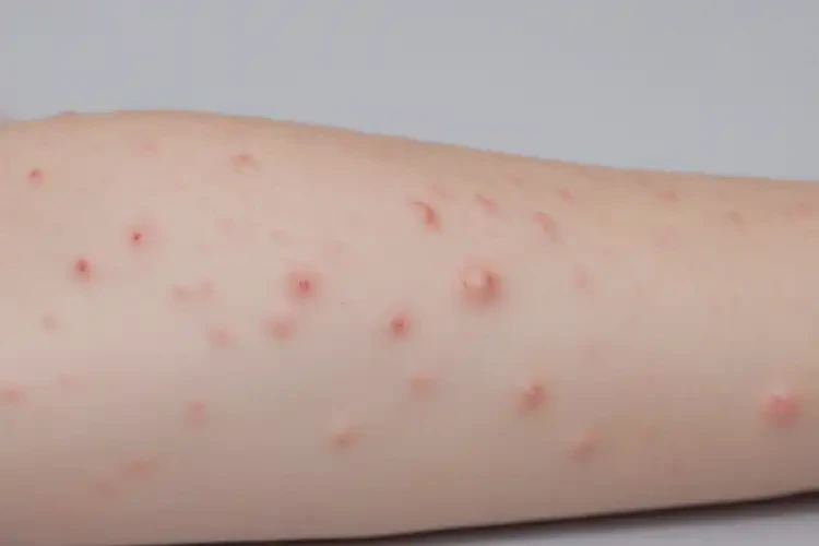 小孩手臂上有濕疹不管它會自己痊愈嗎(圖4)