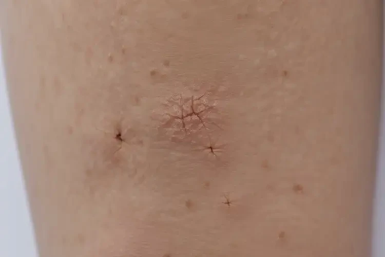 兒童腳上起濕疹不管它會(huì)自己好嗎(圖1)