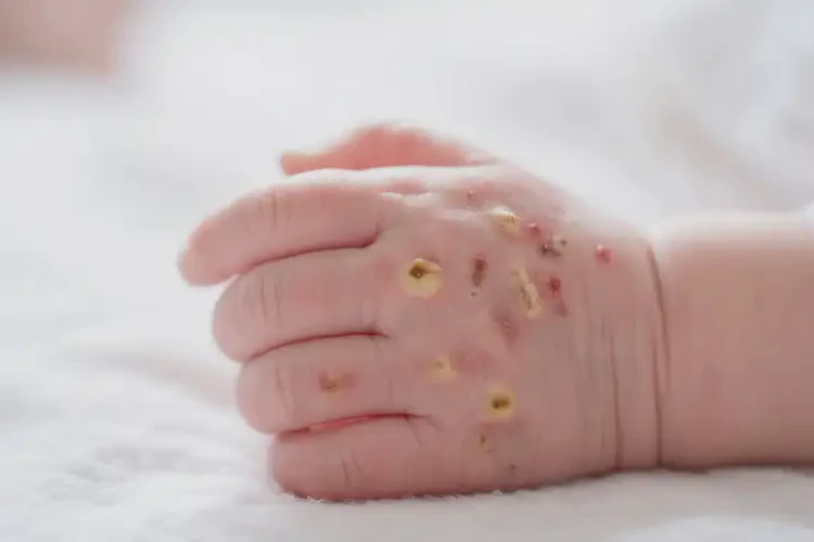 新生兒手上長濕疹不管它會自己好嗎(圖2)