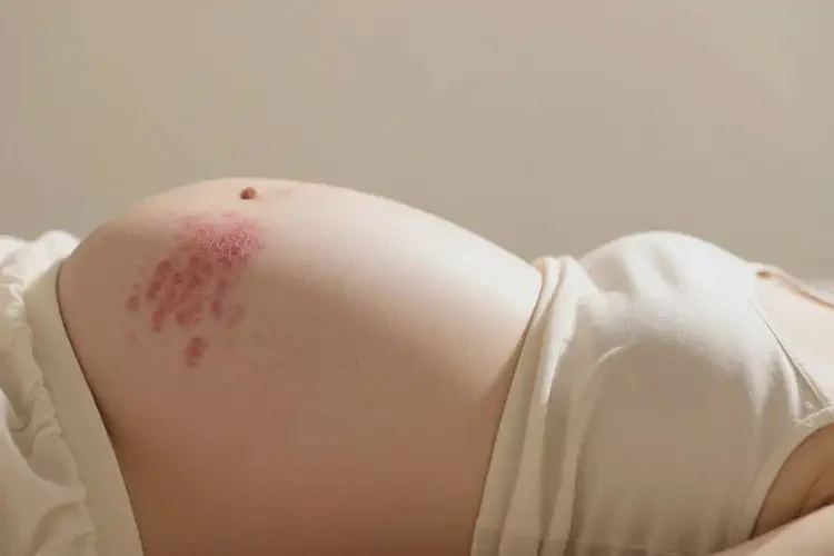 孕妇肚子出湿疹不管它会自己好吗(图4)