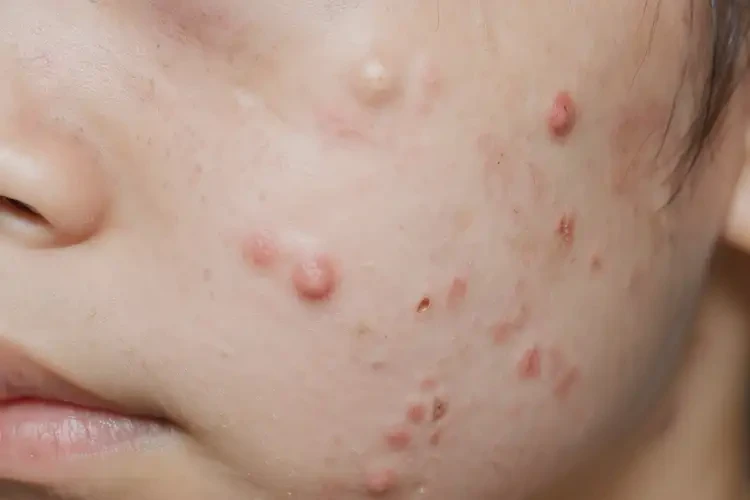 青少年面部容易長(zhǎng)濕疹能徹底自愈嗎(圖4)