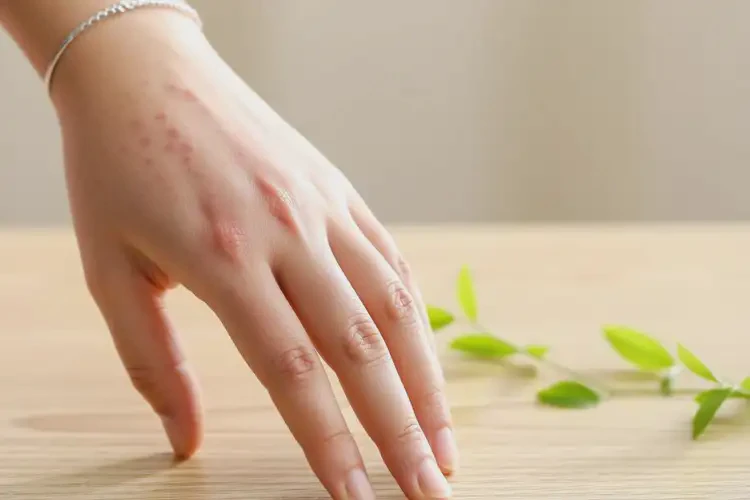 女生手上長(zhǎng)濕疹能徹底自愈嗎(圖4)